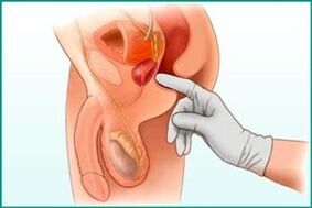 The palpation of the prostate